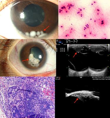 Surgical Resection of Intraocular Tumors (Partial Transscleral Sclerouvectomy Combined With Mircoinvasive Vitrectomy and Reconstruction of the Eyeball) in Asian Patients: Twenty-Five Years Results